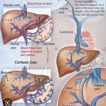 Transjugular Intrahepatic Portosystemic Shunt Diagram