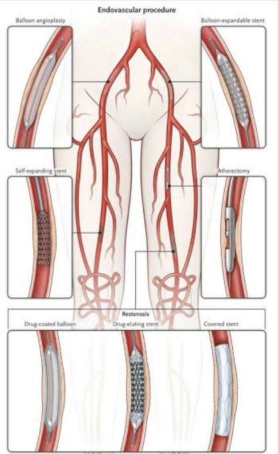 Peripheral Angioplasty