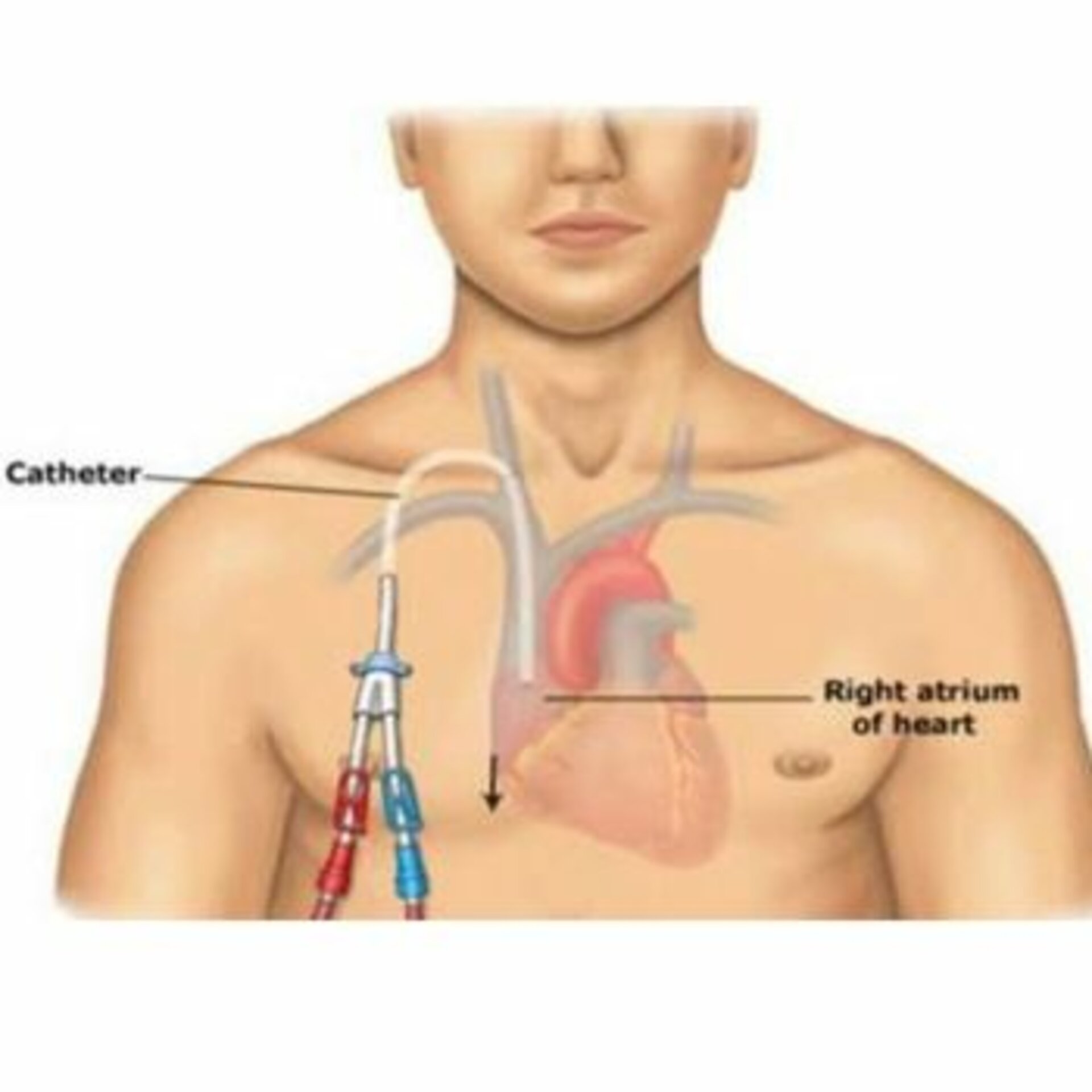 Permacath Insertion for Dialysis
