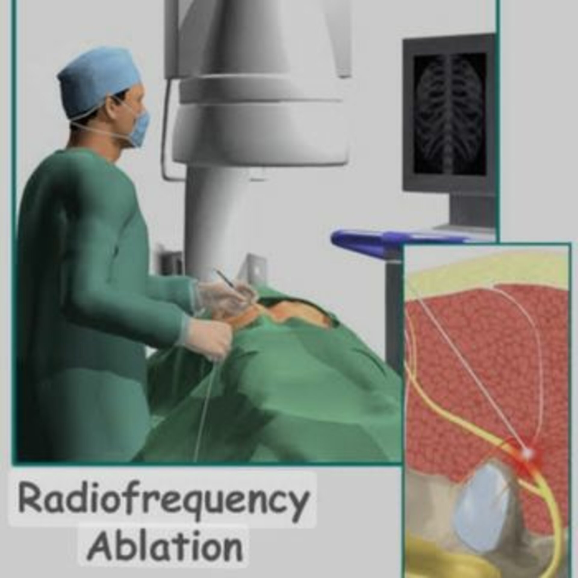 Radiofrequency Ablation