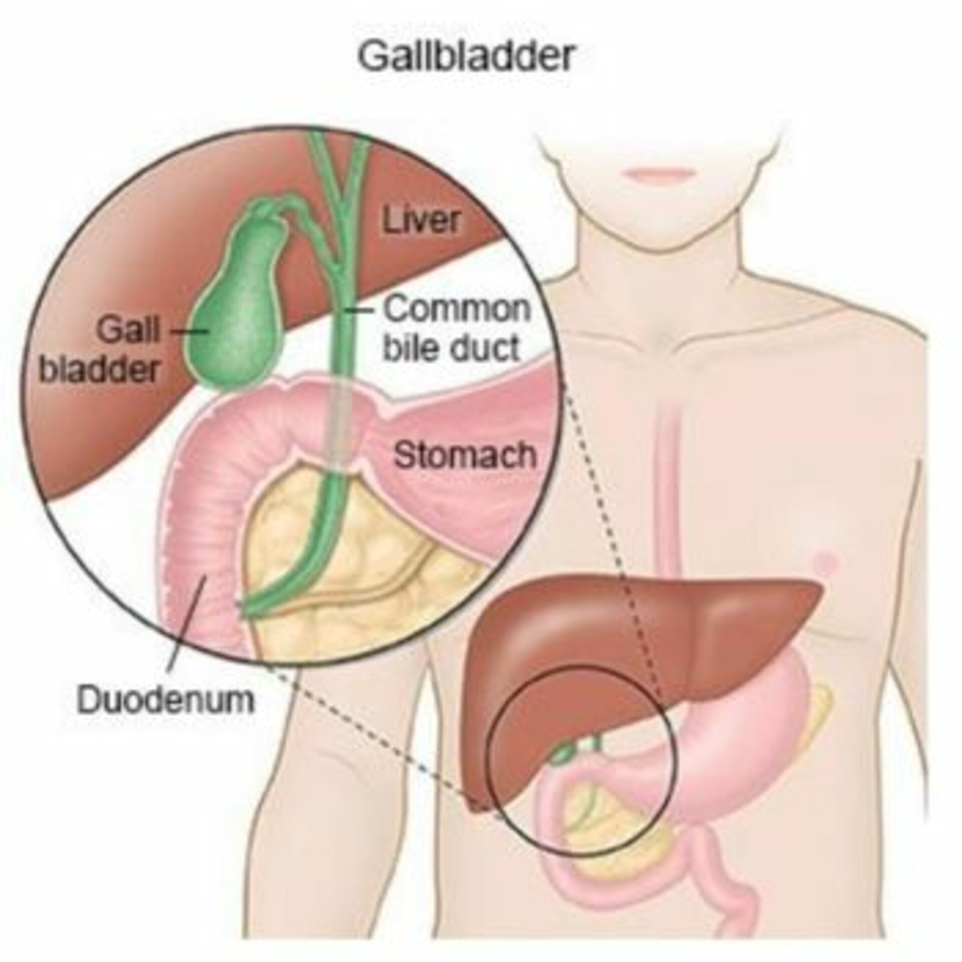 PTBD (Percutaneous Transhepatic Biliary Drainage)