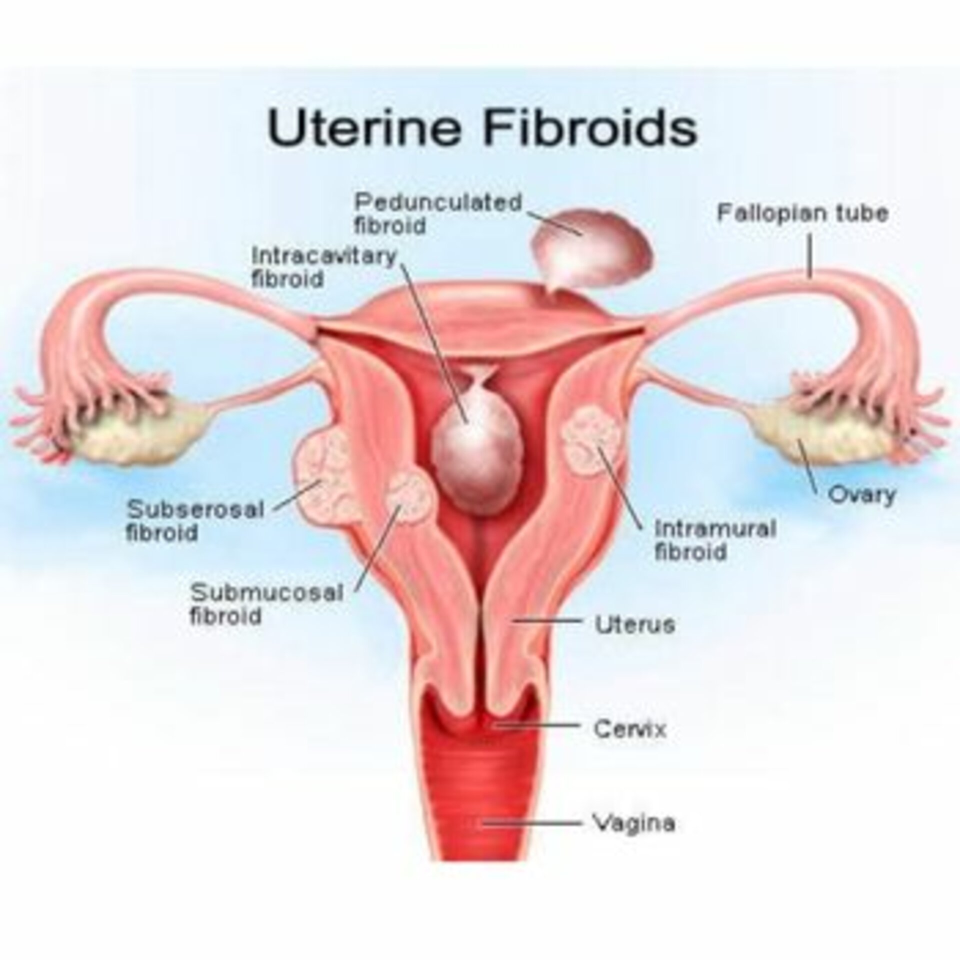 Uterine Artery Embolization
