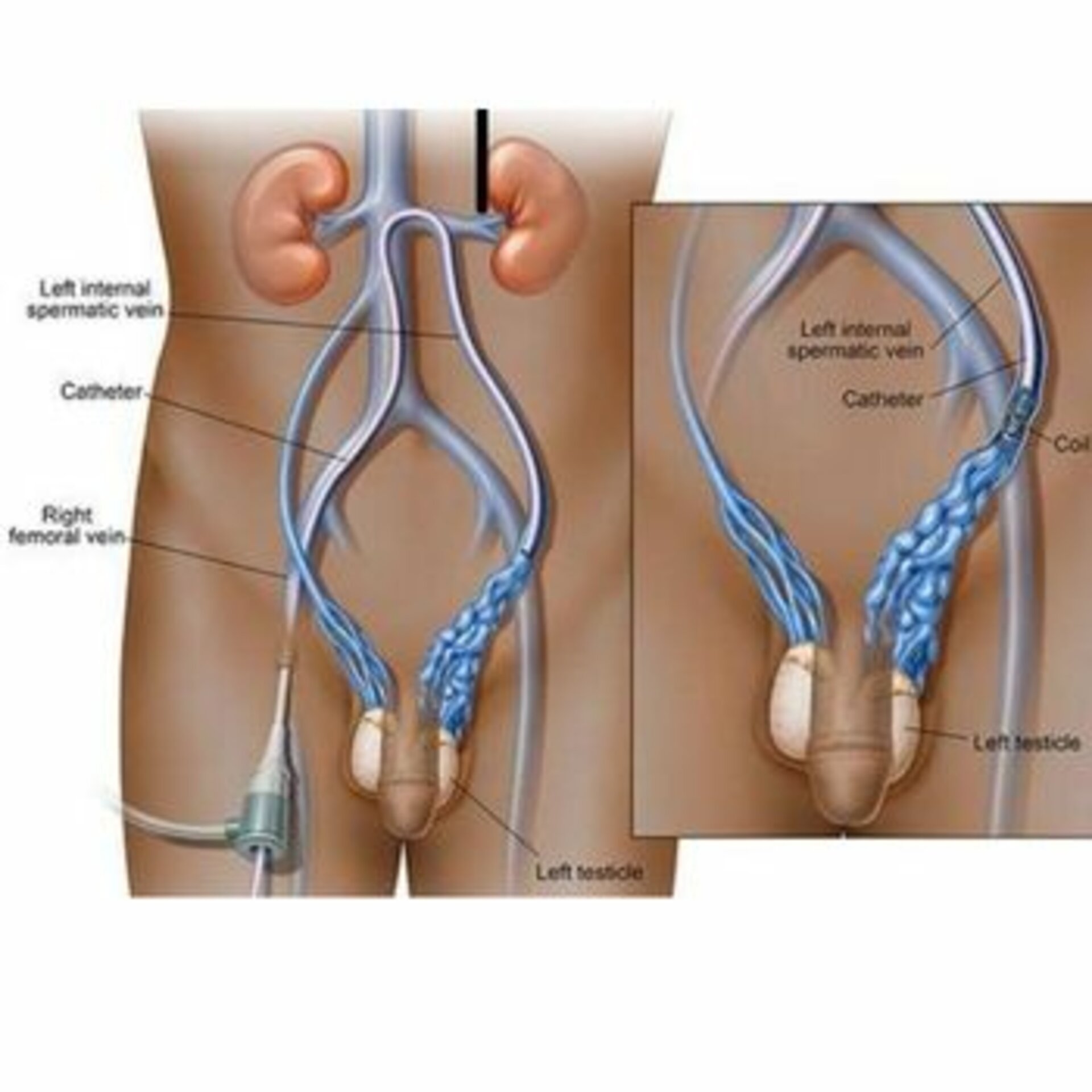 Varicocele Embolization