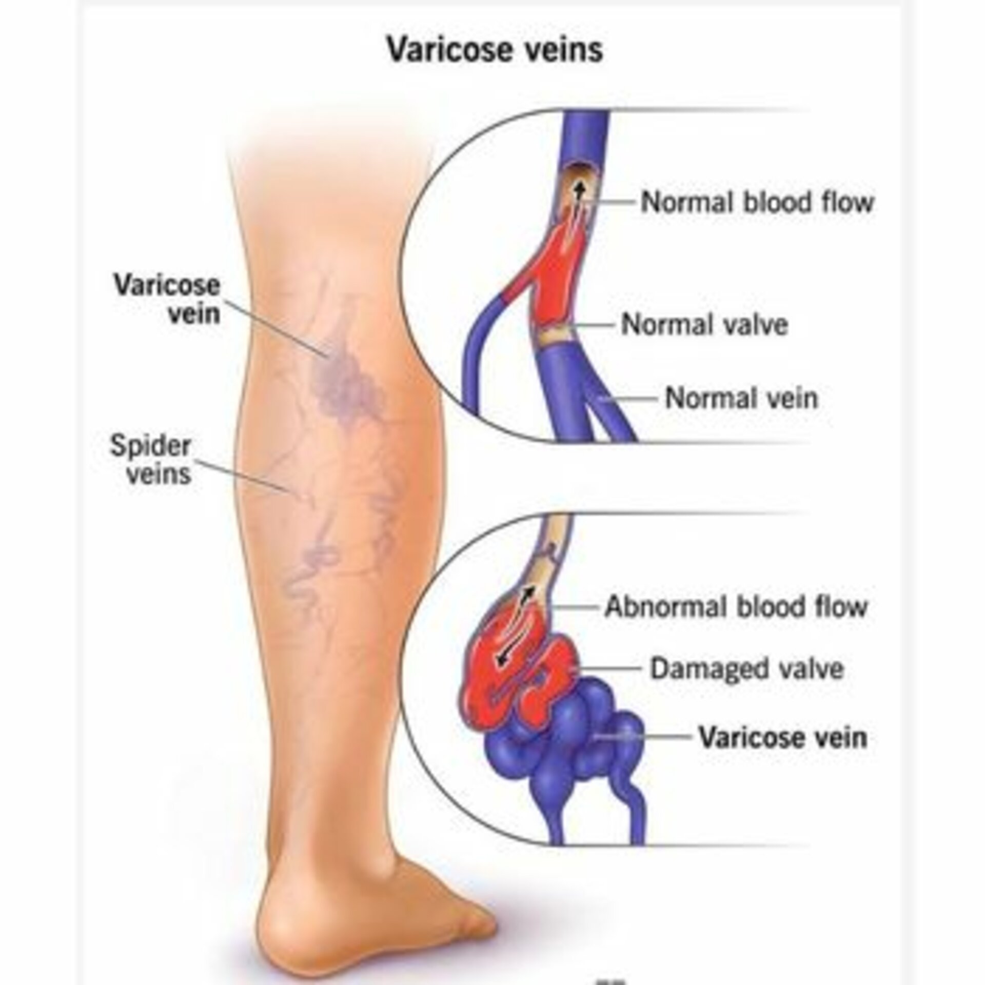Varicose Veins Management